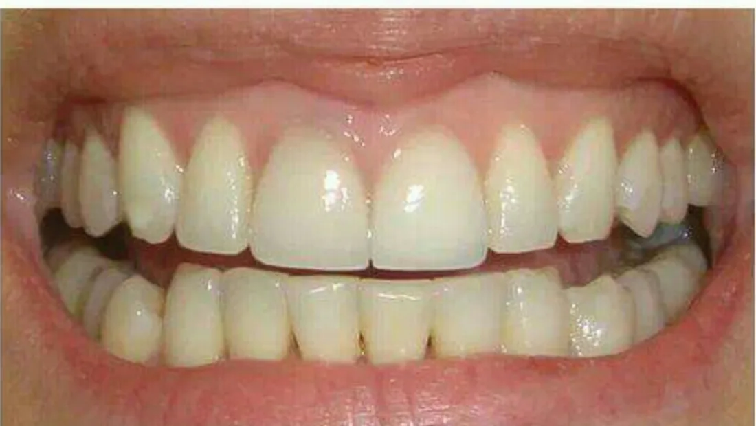 Dientes antes del blanqueamiento