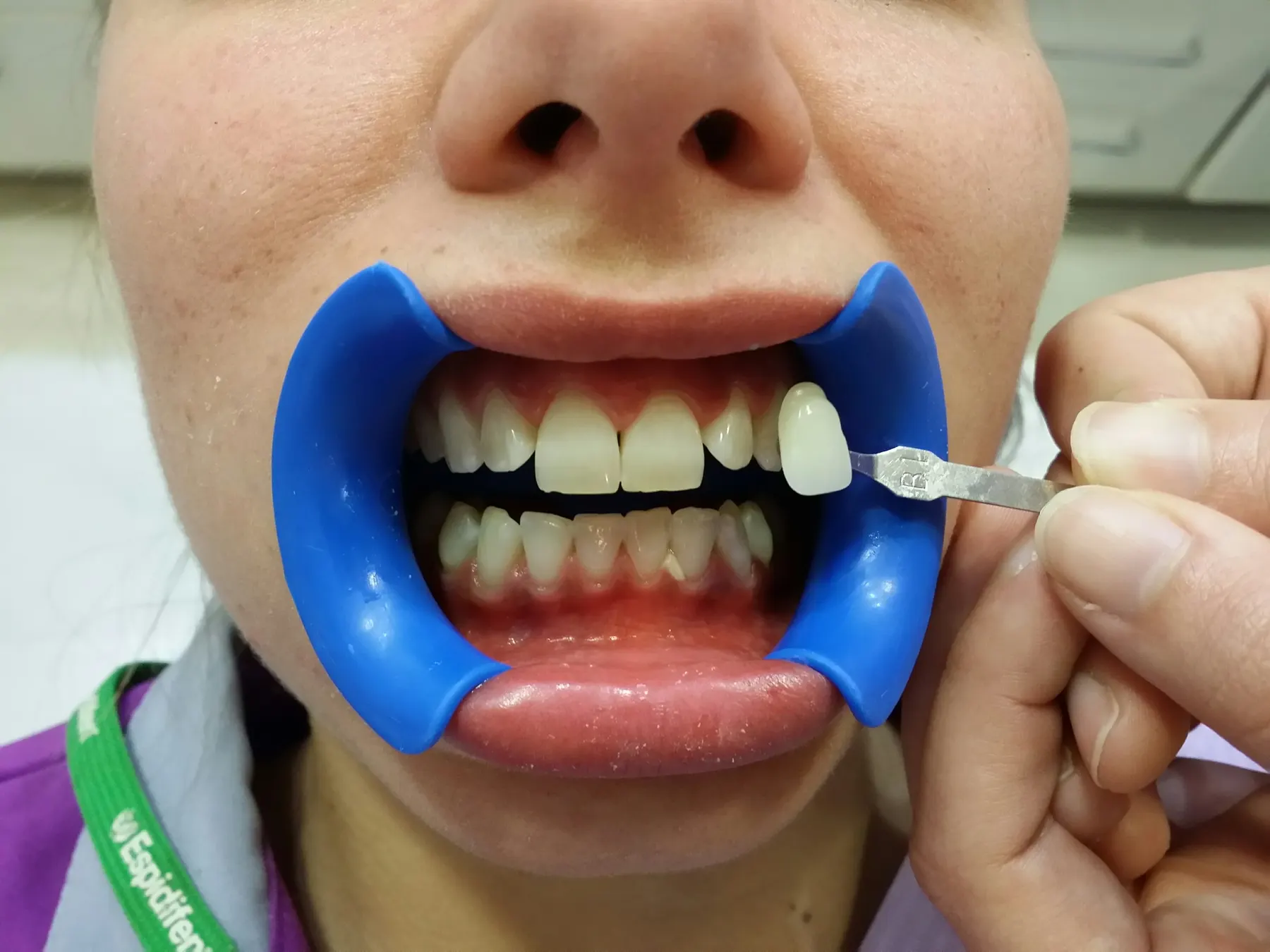 Toma de color antes de un blanqueamiento dental The Smile