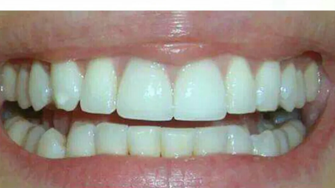 Dientes después del blanqueamiento