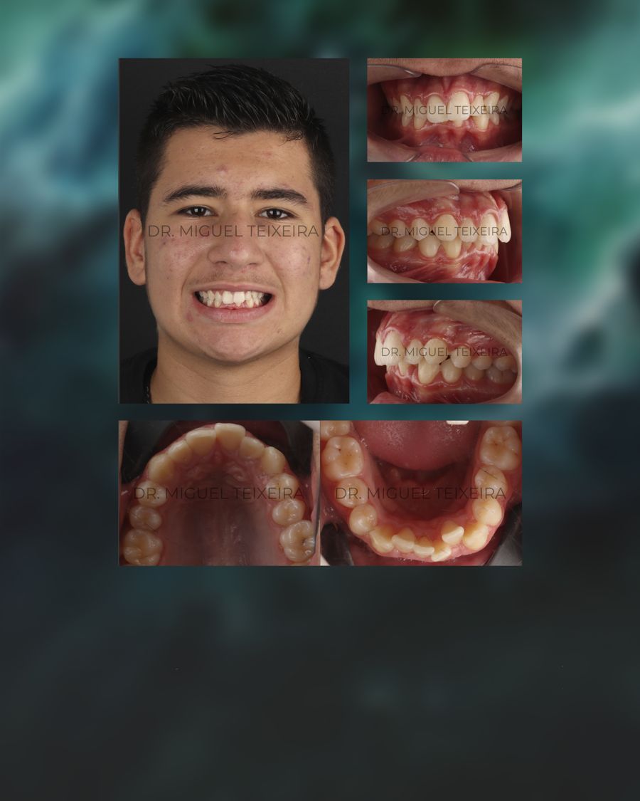 Caso clínico ClearX — periodontitis y diastemas