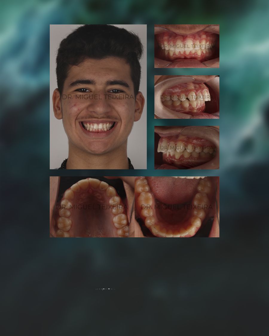 Caso clínico ClearX — diastema y discrepancia de Bolton