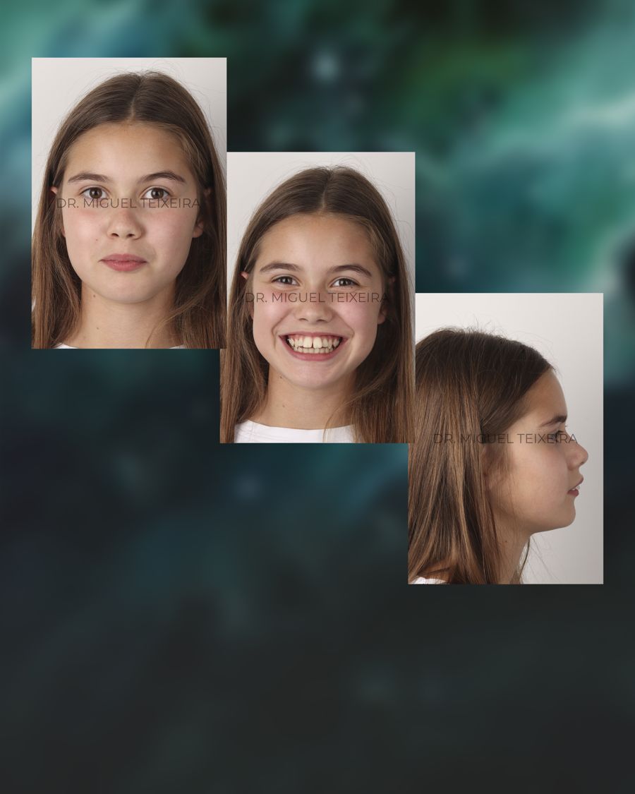Caso clínico ClearX — agenesia y pónticos