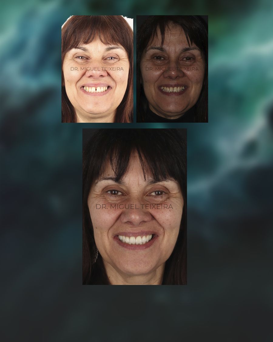 Caso clínico ClearX — transformación de la sonrisa