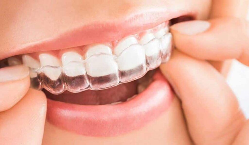 Alineador transparente ClearX