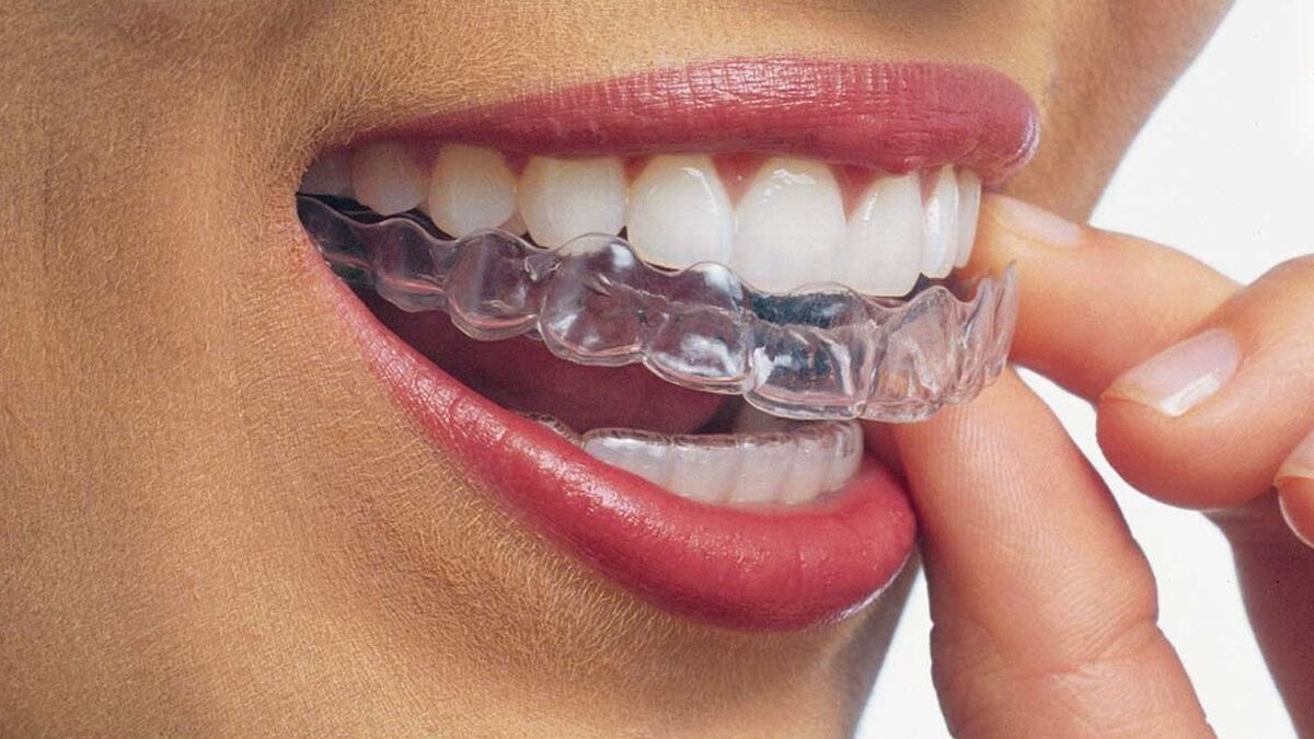 Estructura del alineador ClearX